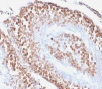 Formalin-fixed, paraffin embedded rat kidney sections stained with 100 ul anti-Wilm s Tumor 1 (clone rWT1/857) at 1:300. HIER epitope retrieval prior to staining was performed in 10mM Citrate, pH 6.0.